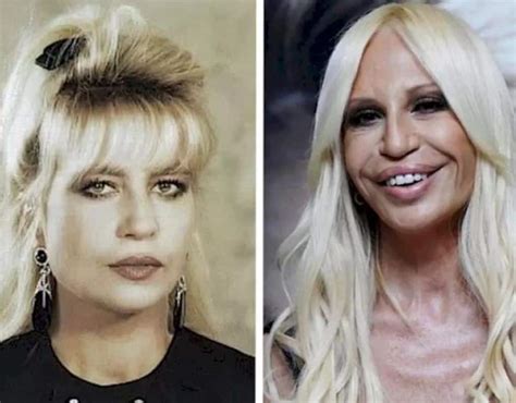 donatella versace face change.